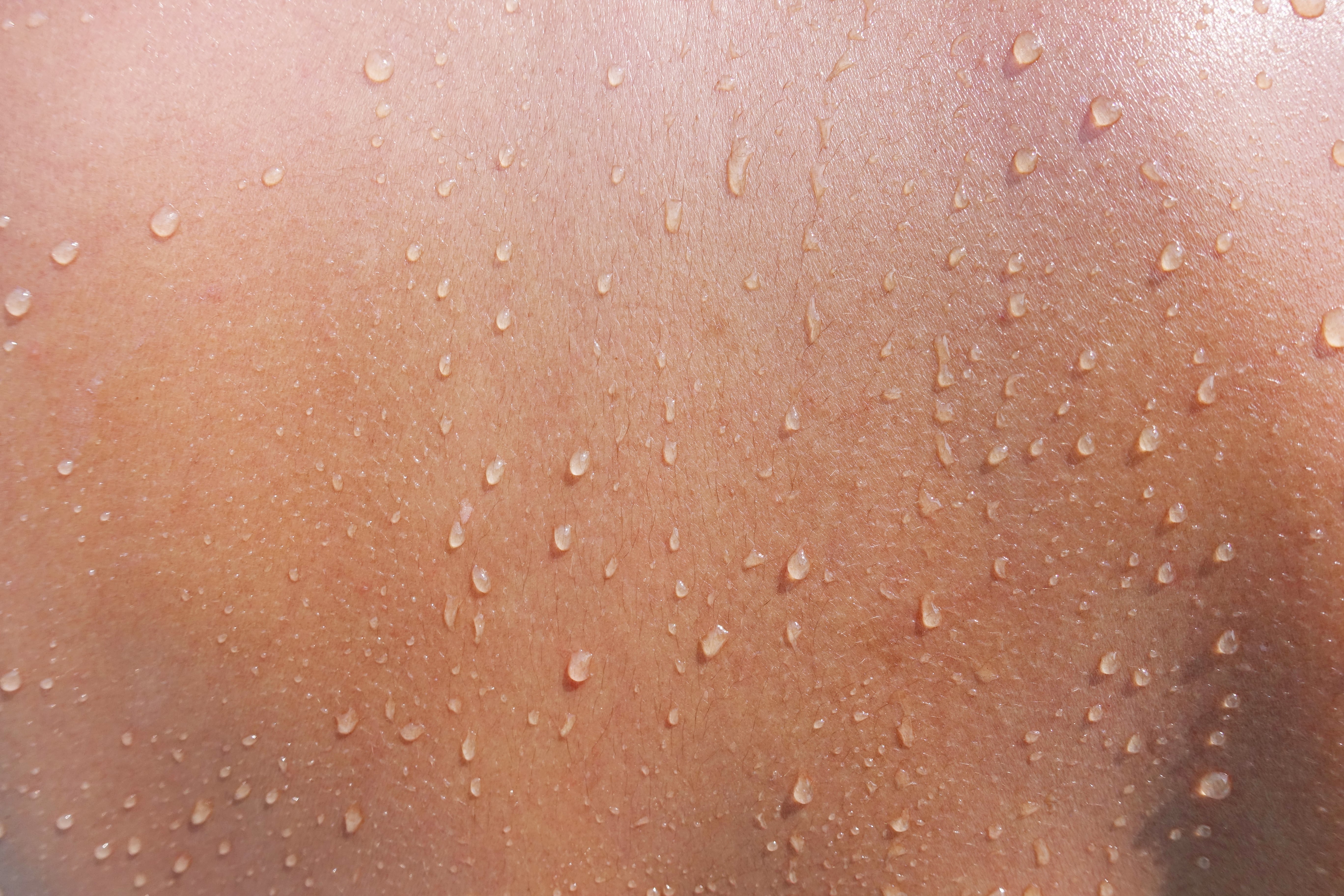 The Skin Barrier & Acne