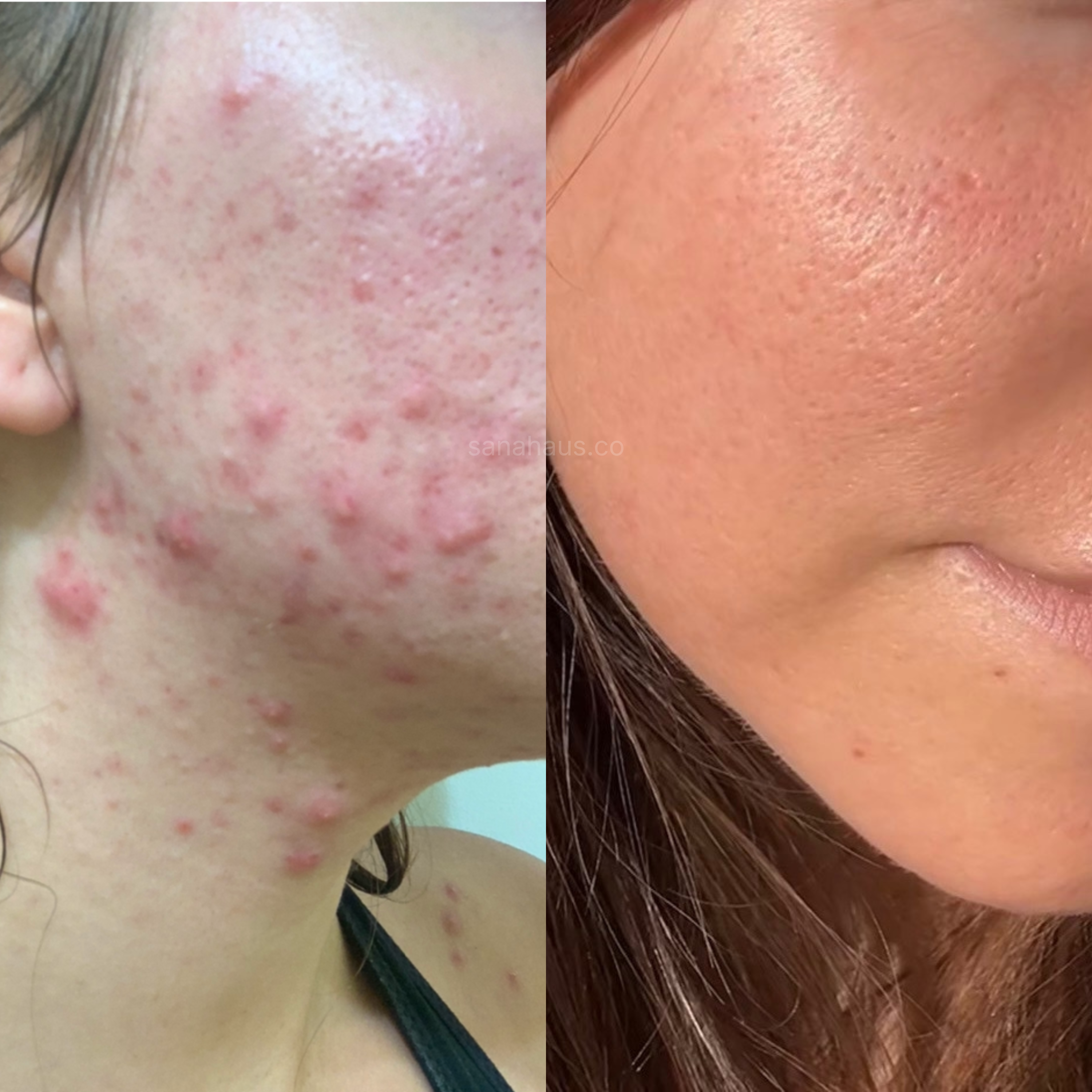 A before and after transformation using face oils for acne.