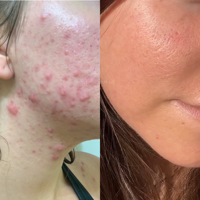 Face Oils for Acne: My Before and After